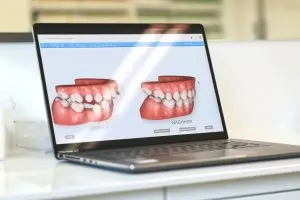 Auf einem Laptop werden kieferorthopädische Zahnmodelle für Zahnkorrektur angezeigt.